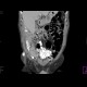 Mesenterium commune, gut malrotation: CT - Computed tomography